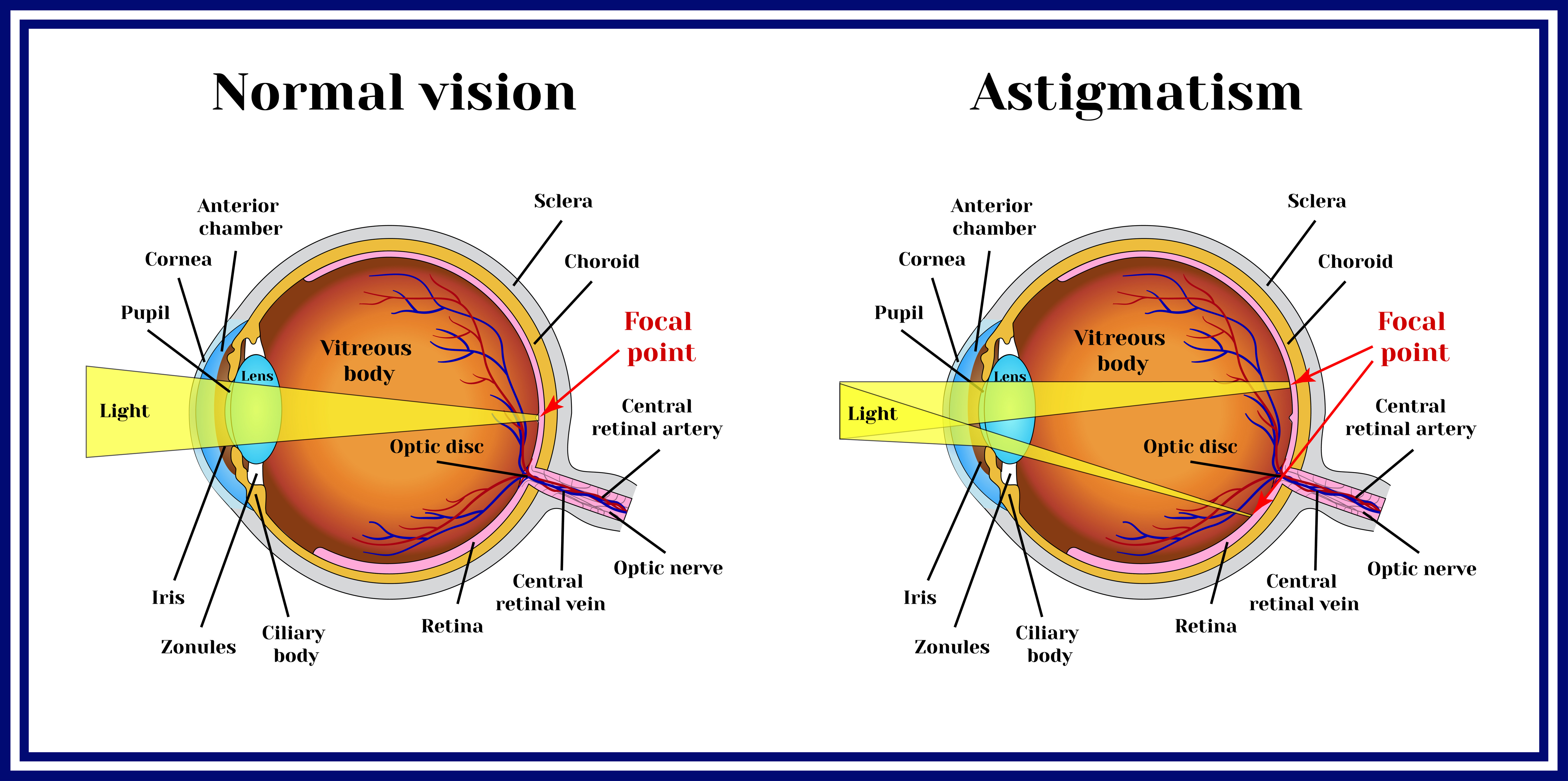 Illustration of eyes with and without Astigmatism